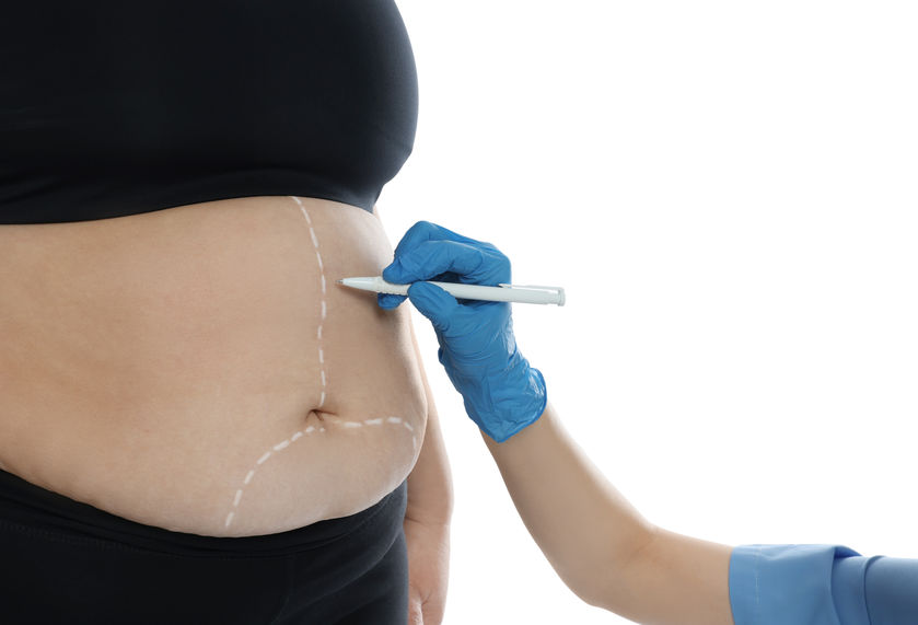 newport-surgicenter-3-Body-Areas-That-Respond-Best-To-Liposuction